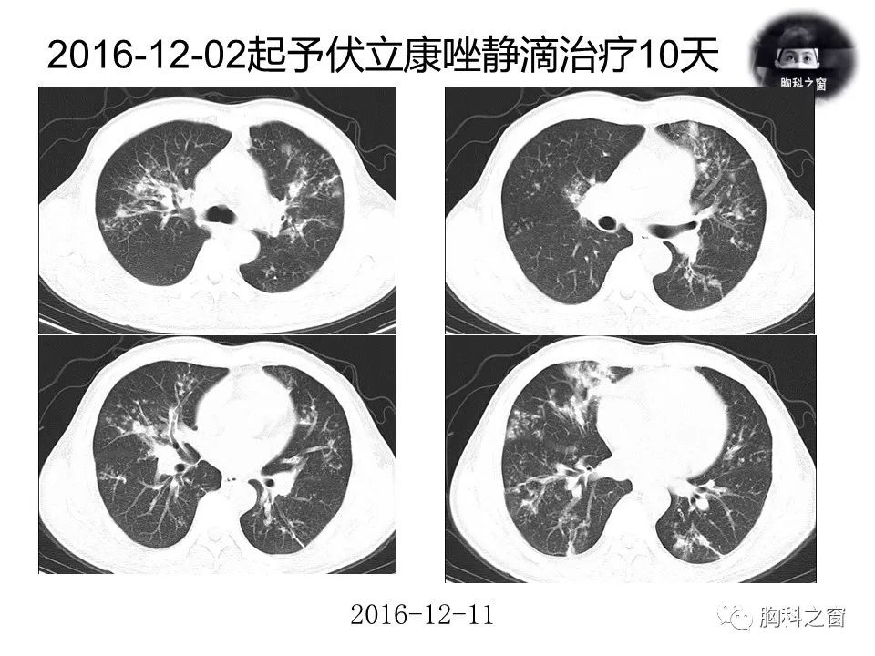 大爷节前大扫除后感染肺曲霉病，警惕卫生清洁中的隐患