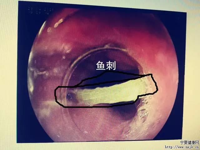 男子遭遇鱼刺危机，一次意外的喉咙冒险之旅