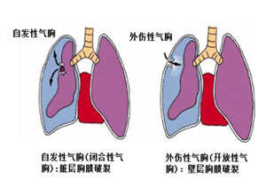 当呼吸变成奢望，气胸的真相揭开，引发生命危机的原因是什么？